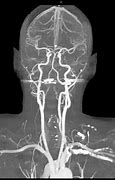 Image result for Carotid Artery Stenosis Symptoms