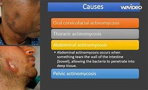 Image result for actinomucosis