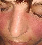 Image result for nokia lupus