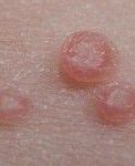 Image result for Skin Virus Molluscum