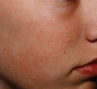 Image result for Skin Build Up On Face