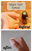 Image result for Essential Oils Wart Removal