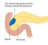Image result for Tumor On Pancreas