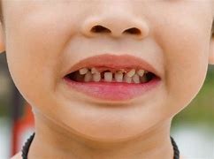 Image result for Kids with Rotten Teeth