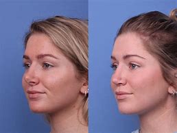 Image result for Rhinoplasty Nose Surgery