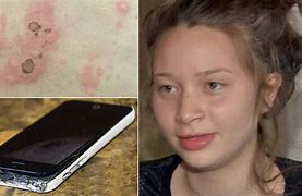 Image result for Cell Phone Burns