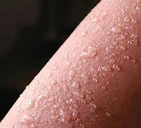 Image result for Sun Burn Rash/Bumps