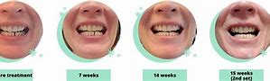 Image result for Byte Teeth Aligners Progess Pictures