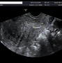Image result for Abnormal Pelvic Ultrasound