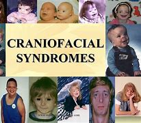 Image result for Craniofacial Anomalies