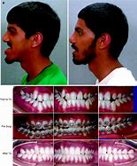 Image result for Cleft Jaw