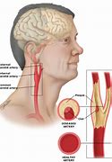 Image result for Ruptured Carotid Artery Aneurysm