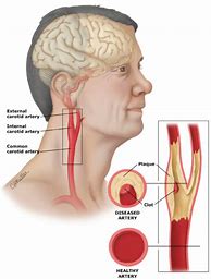 Image result for Path of Internal Carotid Artery