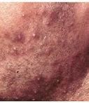 Image result for Folliculitis