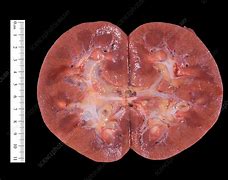 Image result for Normal Kidney CT Scan