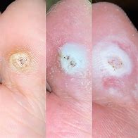 Image result for Dying Common Wart