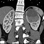 Image result for Kidney Cyst CT Scan