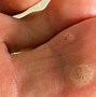 Image result for Plantar Wart Hole in Foot