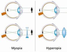 Image result for Myopia and Hyperopia Diagram