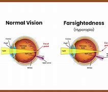 Image result for farsightedness