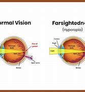 Image result for Farsighted Eye