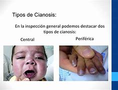 Image result for cianosis