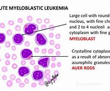 Image result for Acute Lymphoblastic Leukemia Remission