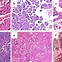 Image result for Lung Cancer Pathology