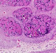 Image result for Inflamed Molluscum