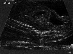 Image result for Fetal Scoliosis Ultrasound