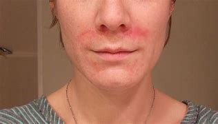 Image result for Eczema Rash On Face