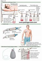 Image result for Chest Tube Drainage