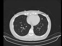 Image result for 12Mm Nodule in Lung