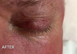 Image result for Wart Inside Eyelid