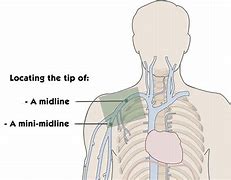 Image result for Midline Catheter Which Vein