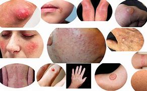 Image result for Pictures of Skin Conditions