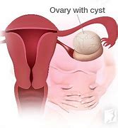 Image result for Ovarian Cyst After Menopause