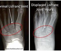Image result for Lisfranc Fracture