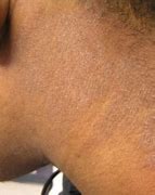 Image result for Eczema Black Skin