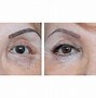 Image result for Papilloma Eyelid Treatment