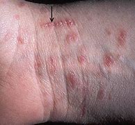 Image result for Scabies Pattern