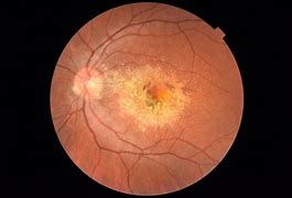 Image result for Retinal Dystrophy