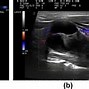 Image result for Parathyroid Masses On Ultrasound