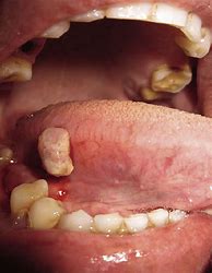 Image result for Papilloma in the Mouth