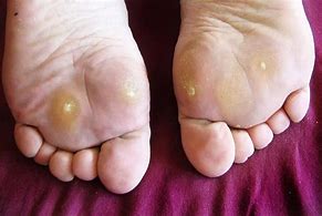 Image result for Black Plantar Wart