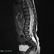 Image result for Meningocele MRI