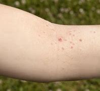 Image result for Molluscum Contagiosum Itchy
