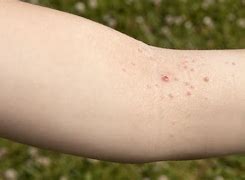 Image result for Molluscum Contagiosum Spreading All Over