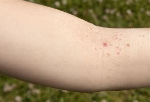 Image result for Molluscum Contagiosum Symptoms in Women