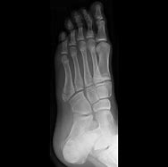 Image result for Base of 5th Metatarsal Apophysis